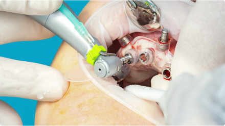 guided-implant-surgery-image